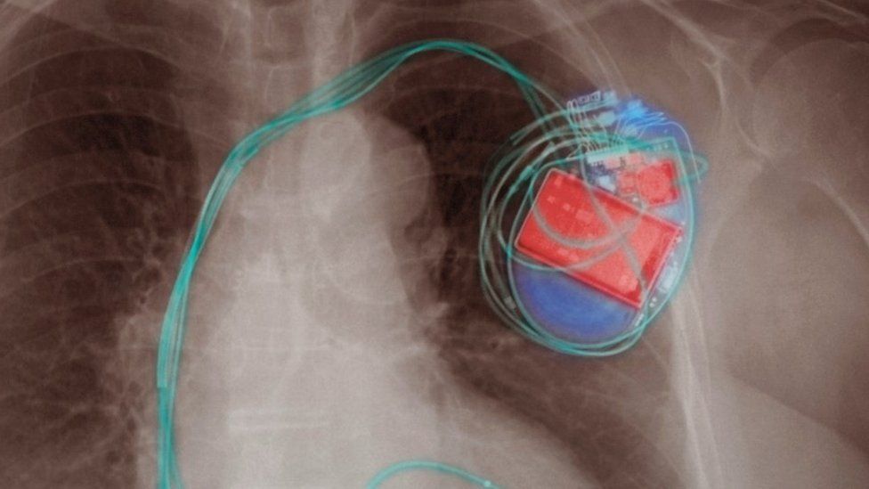 Apple кардиостимулятор