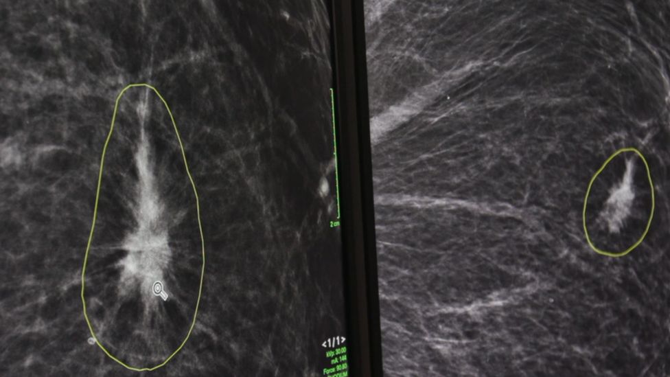 Areas of concern circled on a mammogram by AI software